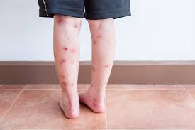 Bed Bugs